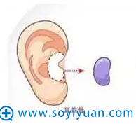 耳软骨隆鼻尖 耳软骨隆鼻尖