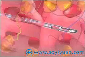 钝针注射 钝针注射