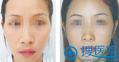 自体脂肪编码植入技术丰颞案例 自体脂肪编码植入技术丰颞案例