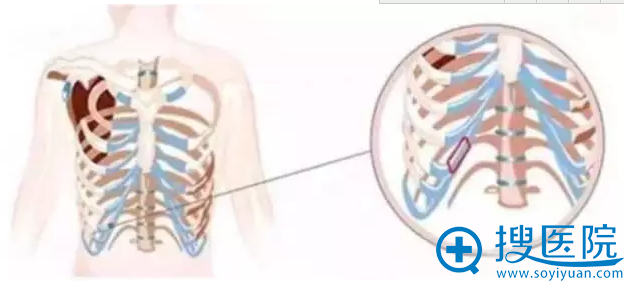肋软骨隆鼻尖 肋软骨隆鼻尖