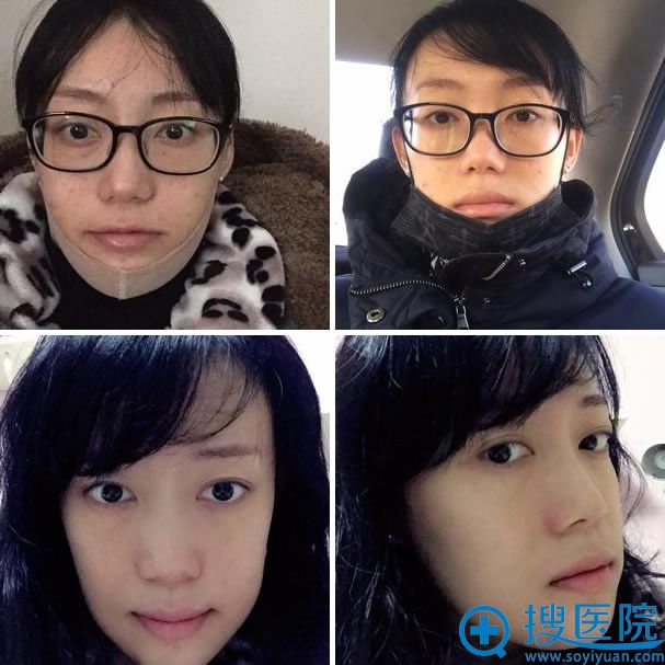 vline瓜子脸手术第13天恢复效果 vline瓜子脸手术第13天恢复效果