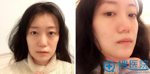 下颌角和下巴整形手术第47天 下颌角和下巴整形手术第47天