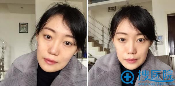 下巴整形手术第64天 下巴整形手术第64天