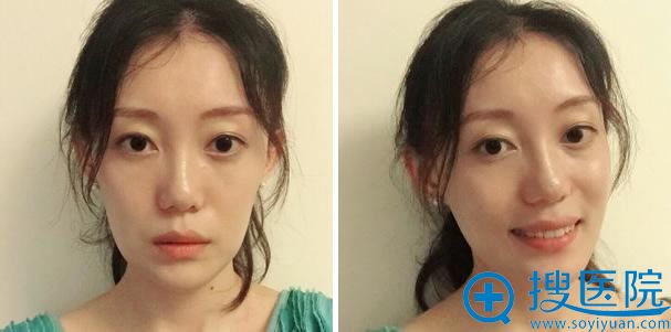 vline瓜子脸整形手术第290天 vline瓜子脸整形手术第290天