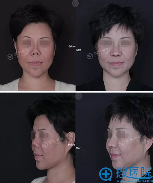 北京沃尔刘彦军鼻综合修复案例效果图 北京沃尔刘彦军鼻综合修复案例效果图