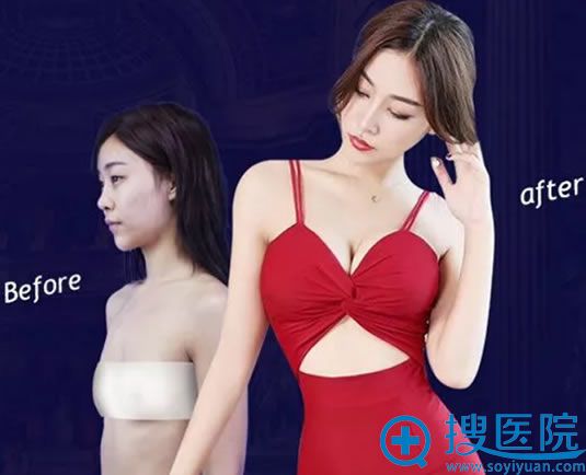 济南海峡李德庆隆胸案例 济南海峡李德庆隆胸案例