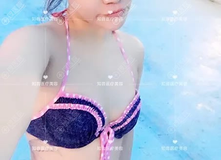 做假体隆胸前的A罩杯照片 做假体隆胸前的A罩杯照片