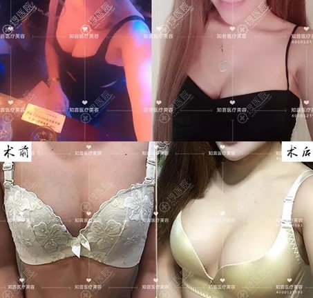做完假体隆胸4个月恢复照片 做完假体隆胸4个月恢复照片