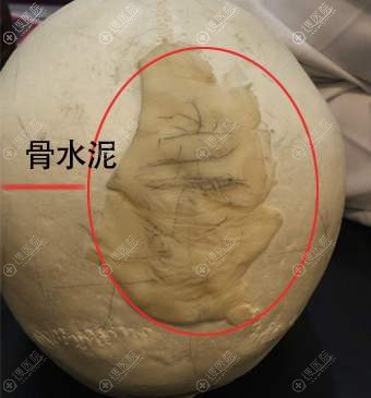 骨水泥填充材料 骨水泥填充材料