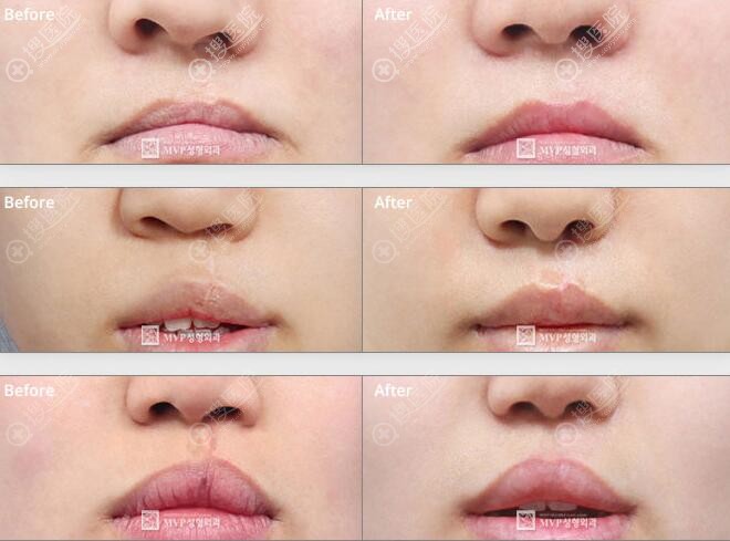 韩国MVP唇腭裂疤痕修复对比效果 韩国MVP唇腭裂疤痕修复对比效果