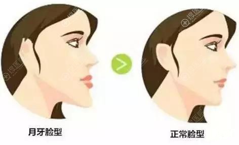 正颌手术前后对比效果 正颌手术前后对比效果
