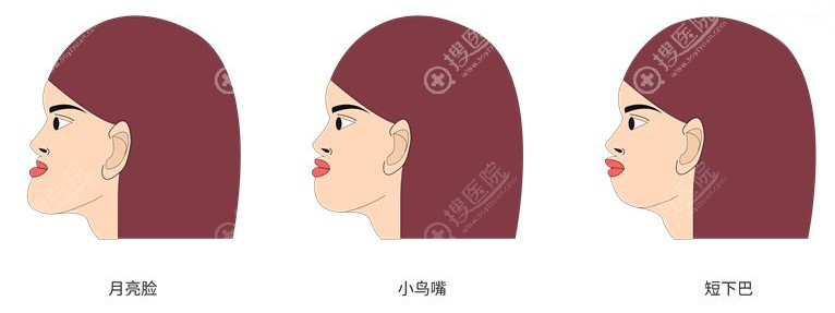 需要做正颌手术的人群 需要做正颌手术的人群