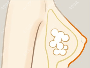 自体脂肪隆胸能维持多长时间? 自体脂肪隆胸能维持多长时间?