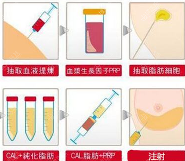 自体脂肪丰胸流程图 自体脂肪丰胸流程图