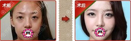 自体脂肪填充苹果肌效果 自体脂肪填充苹果肌效果