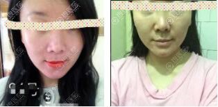 自体脂肪填充苹果肌后泪沟深 自体脂肪填充苹果肌后泪沟深