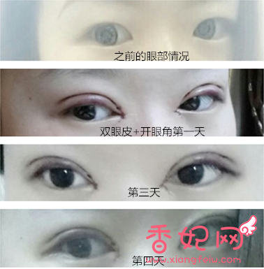【案例】上海伊莱美医疗美容医院孙美庆割双眼皮开眼角怎么样