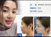 雅美整形,全新俏佳人无痕美鼻