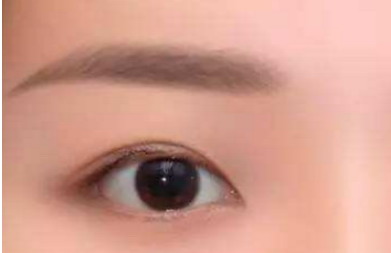 假体垫眉弓七天图